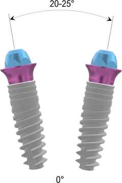Схема XGate Dental: прямой D-type, расхождение до 20–25°; схема без кости и десны, не в масштабе
