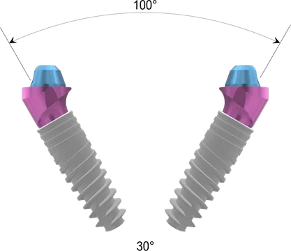 Схема XGate Dental: угловой D-type 30°, расхождение до 100°; схема без кости и десны, не в масштабе